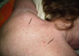 Acupuncture